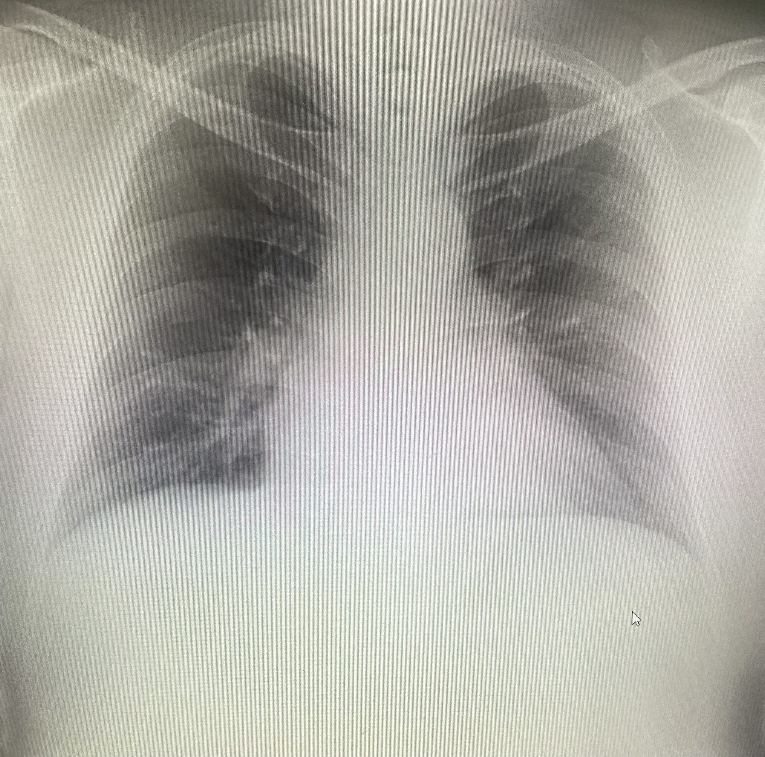 胸部レントゲン写真の結果